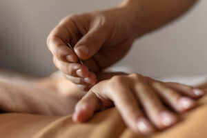 Read more about the article The Amazing Benefits of Acupuncture