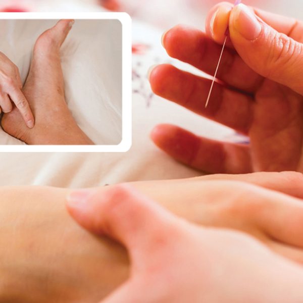 Acupuncture